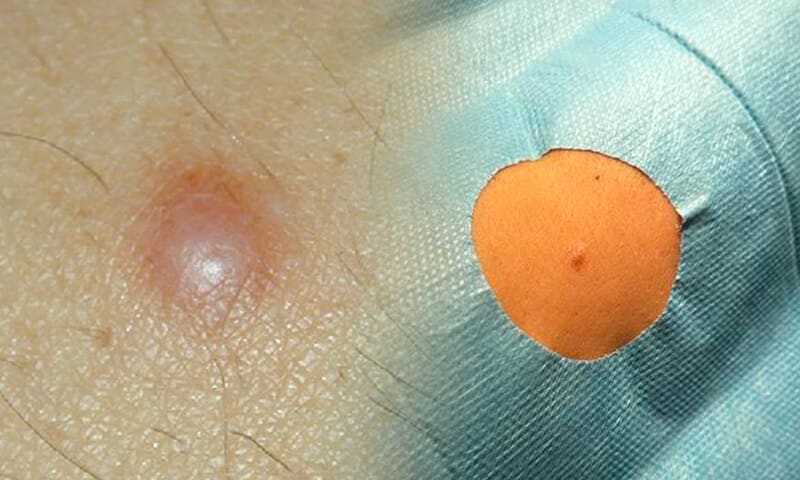 Dermatofibroma
