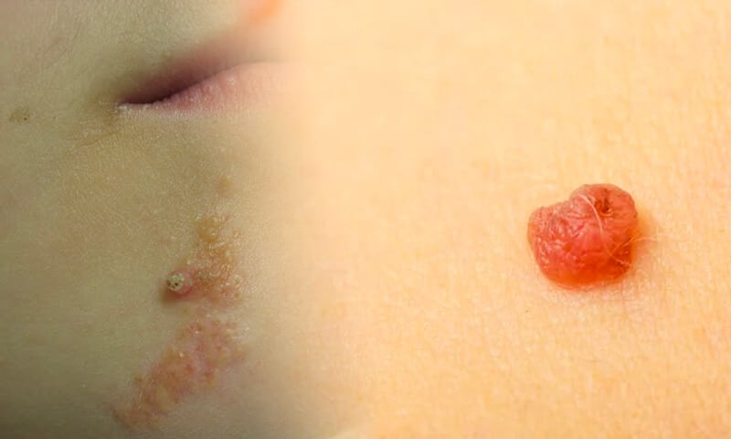 Nevo epidermico