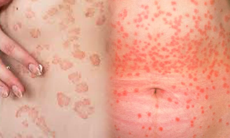 Psoriasi guttata