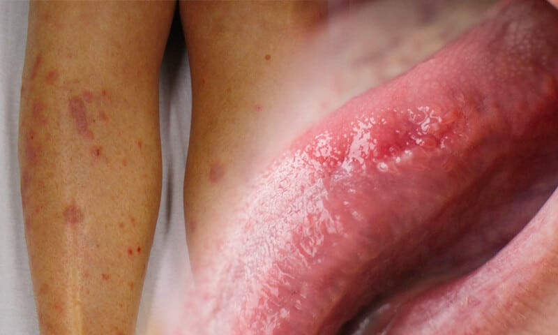 Lichen planus