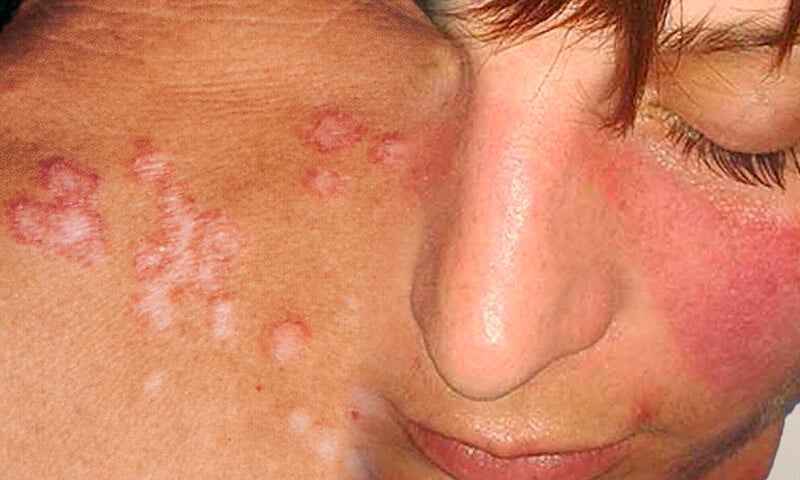 Lupus eritematoso sistemico