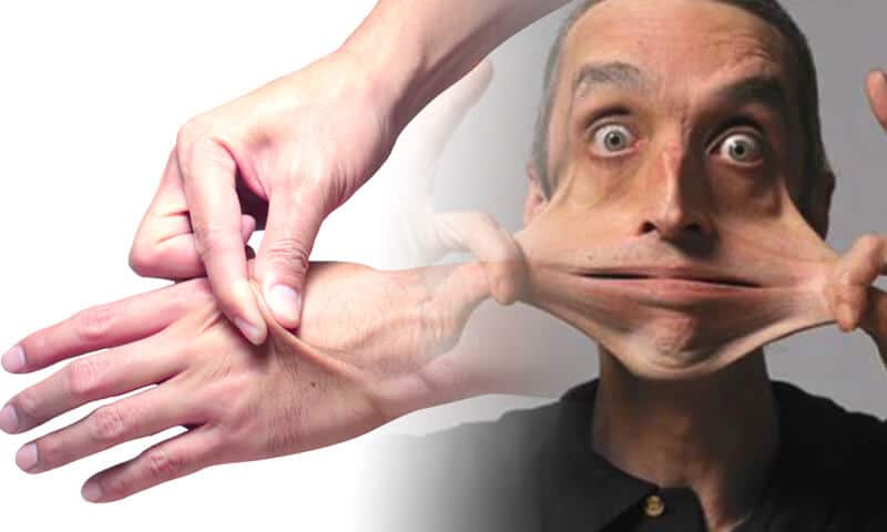 Sindrome di Ehlers-Danlos
