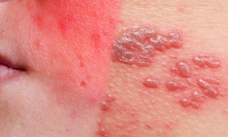 Sindrome di Stevens-Johnson