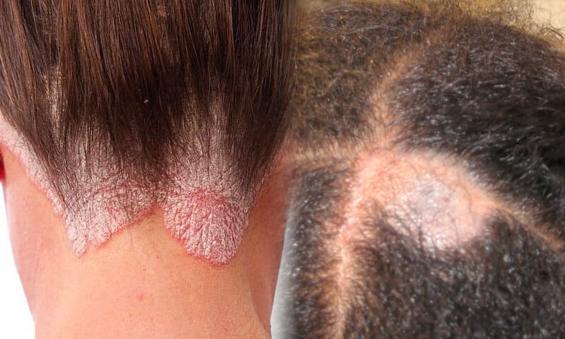 Tinea capitis
